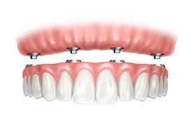 Prótesis fijas y Prótesis sobre implantes dentales