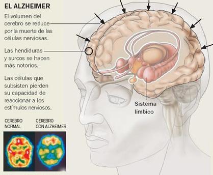 Patient with Alzheimer´s disease