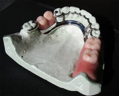 The Pemovable Partial Denture